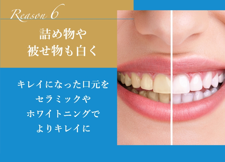 詰め物や被せ物も白く