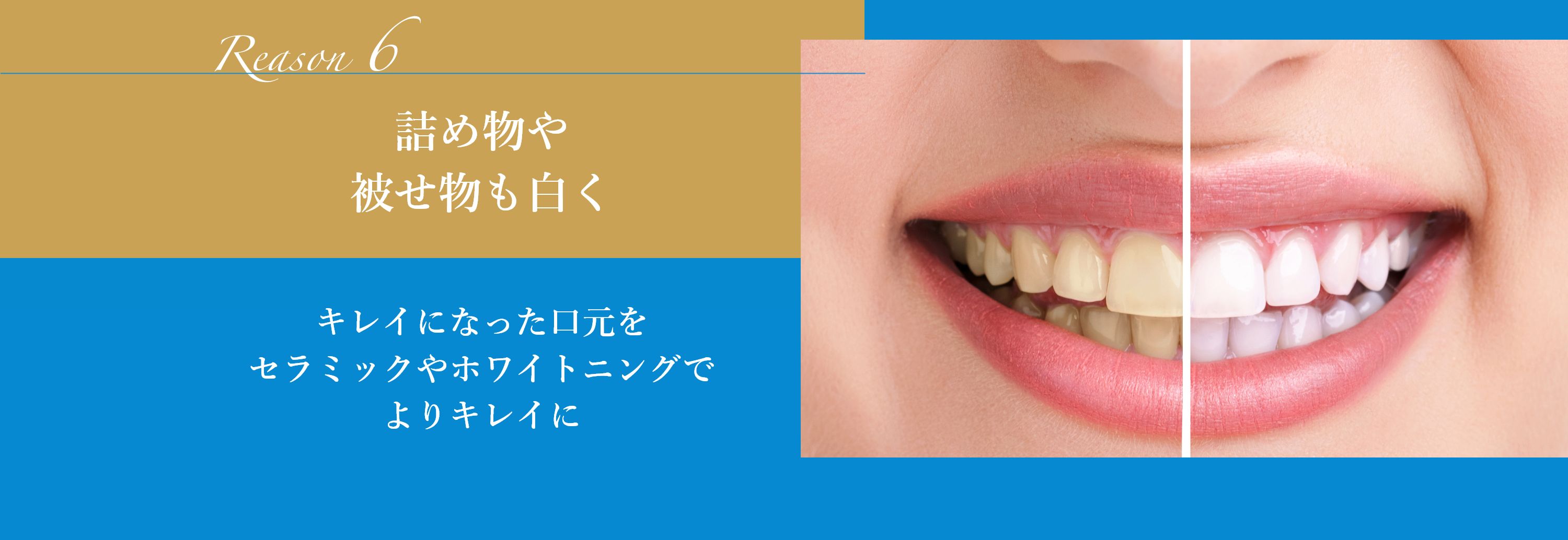 詰め物や被せ物も白く