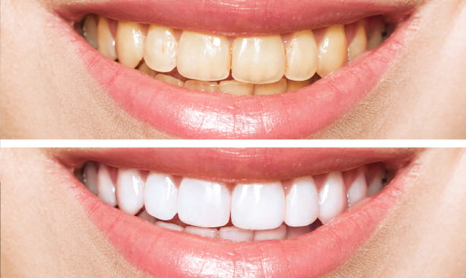 なぜ歯の色は変わってしまうの？