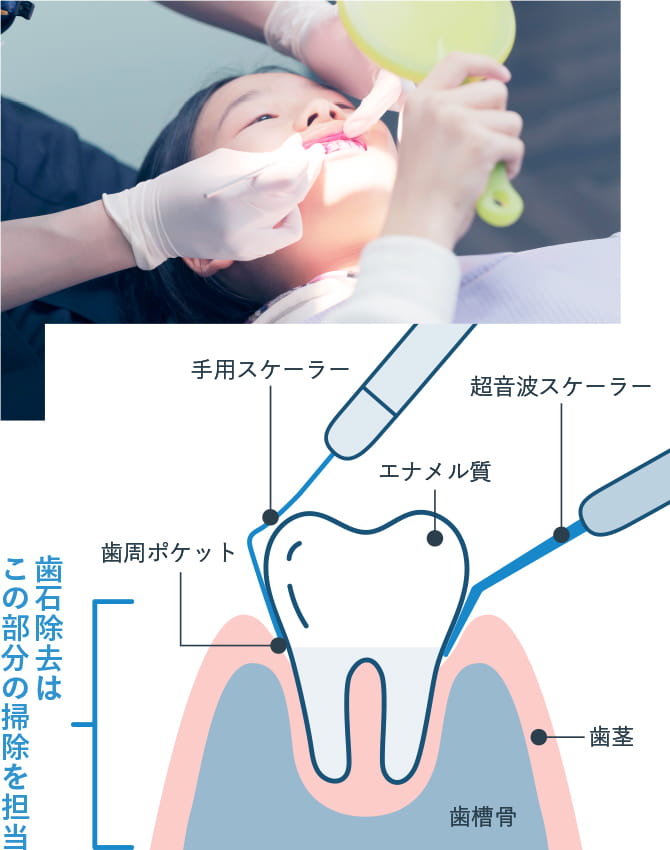 歯石除去（保険対応）