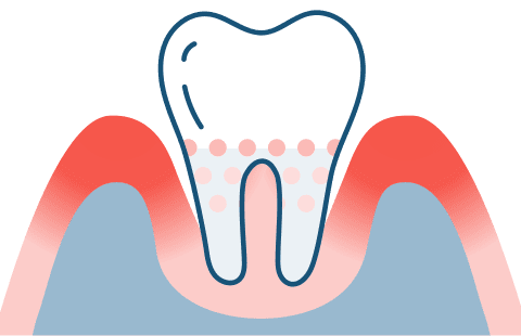 歯周病治療イラスト