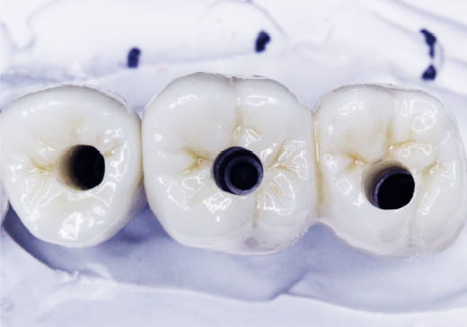 プロビジョナルレストレーション（プロビ）