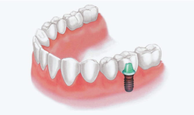 歯を根本から作り直す『インプラント治療』