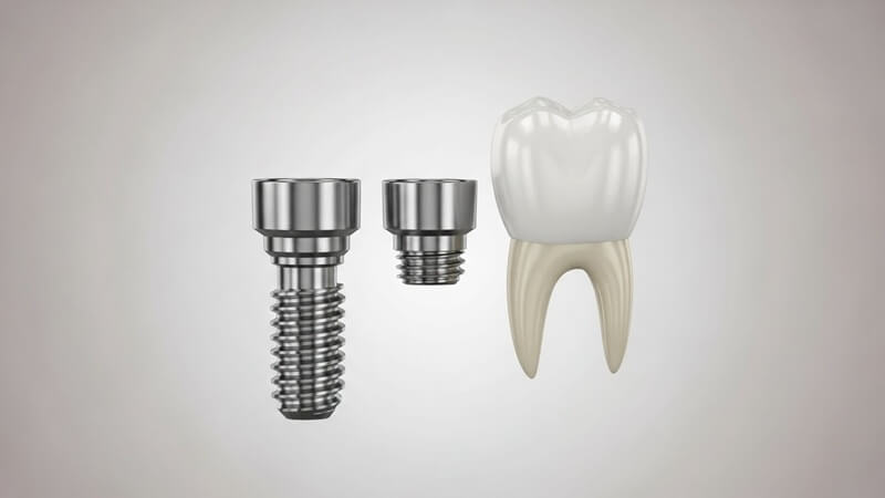 インプラントの種類を確認する前に知りたい基本的な構造