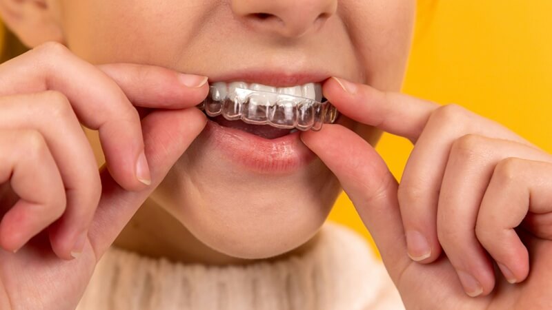 すきっ歯治療では専門家の診断を受けよう