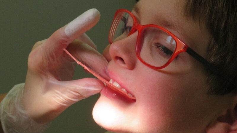 子供における過蓋咬合の原因3選