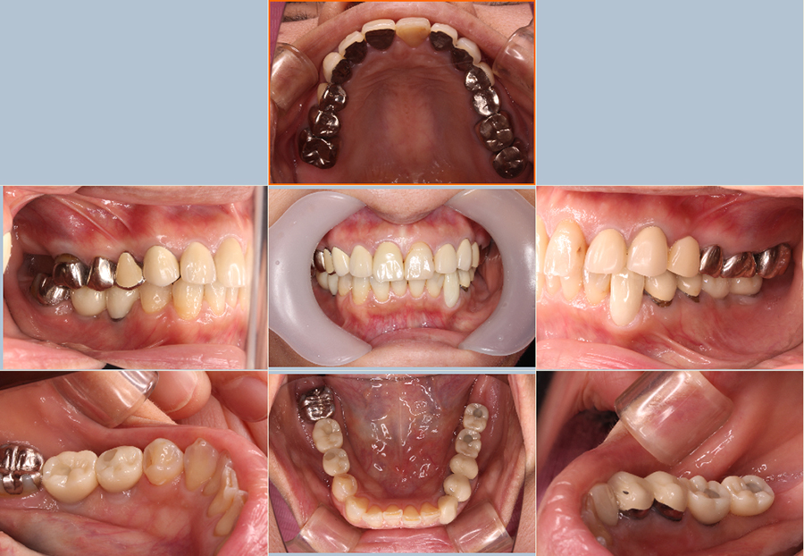 クリア歯科 インプラント症例