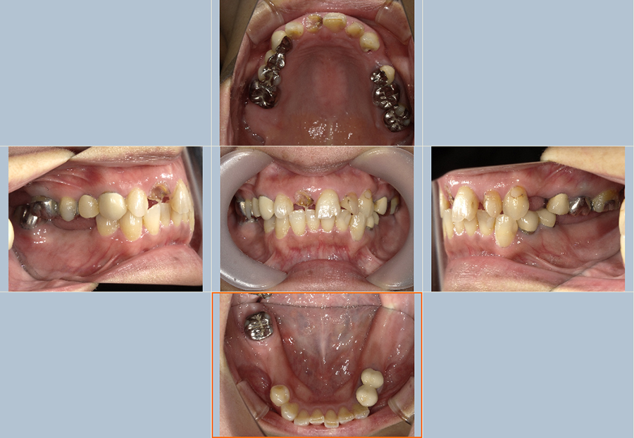 クリア歯科 インプラント症例